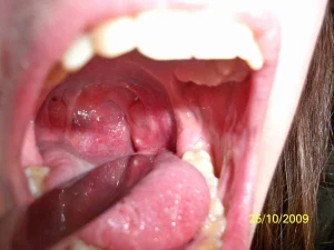 How Rare Is It For Tonsils To Grow Back 0 300x225 jpg