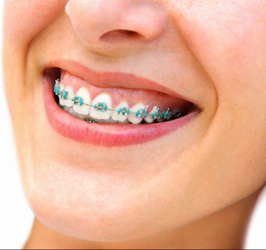 Is Light Blue A Good Braces Color 