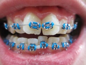 What Is The Best Color For Brace 3