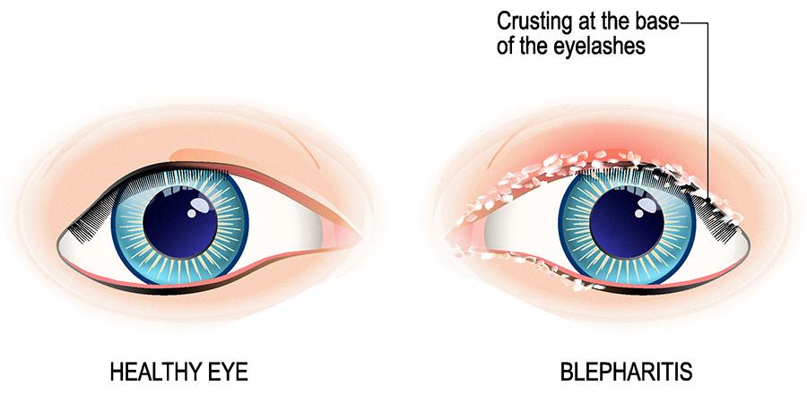 blepharitis in eyelash extensions