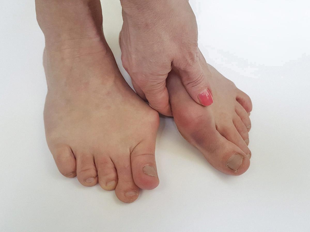 Bunions vs Bone Spurs Key Differences and Treatments