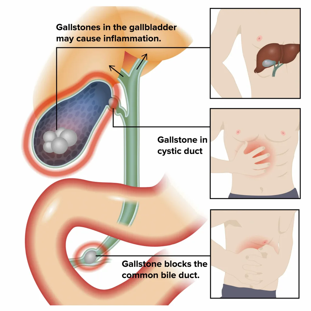 can-a-bad-gallbladder-kill-you-the-risks-of-untreated-cholecystitis