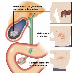 can a bad gallbladder kill you 1 1