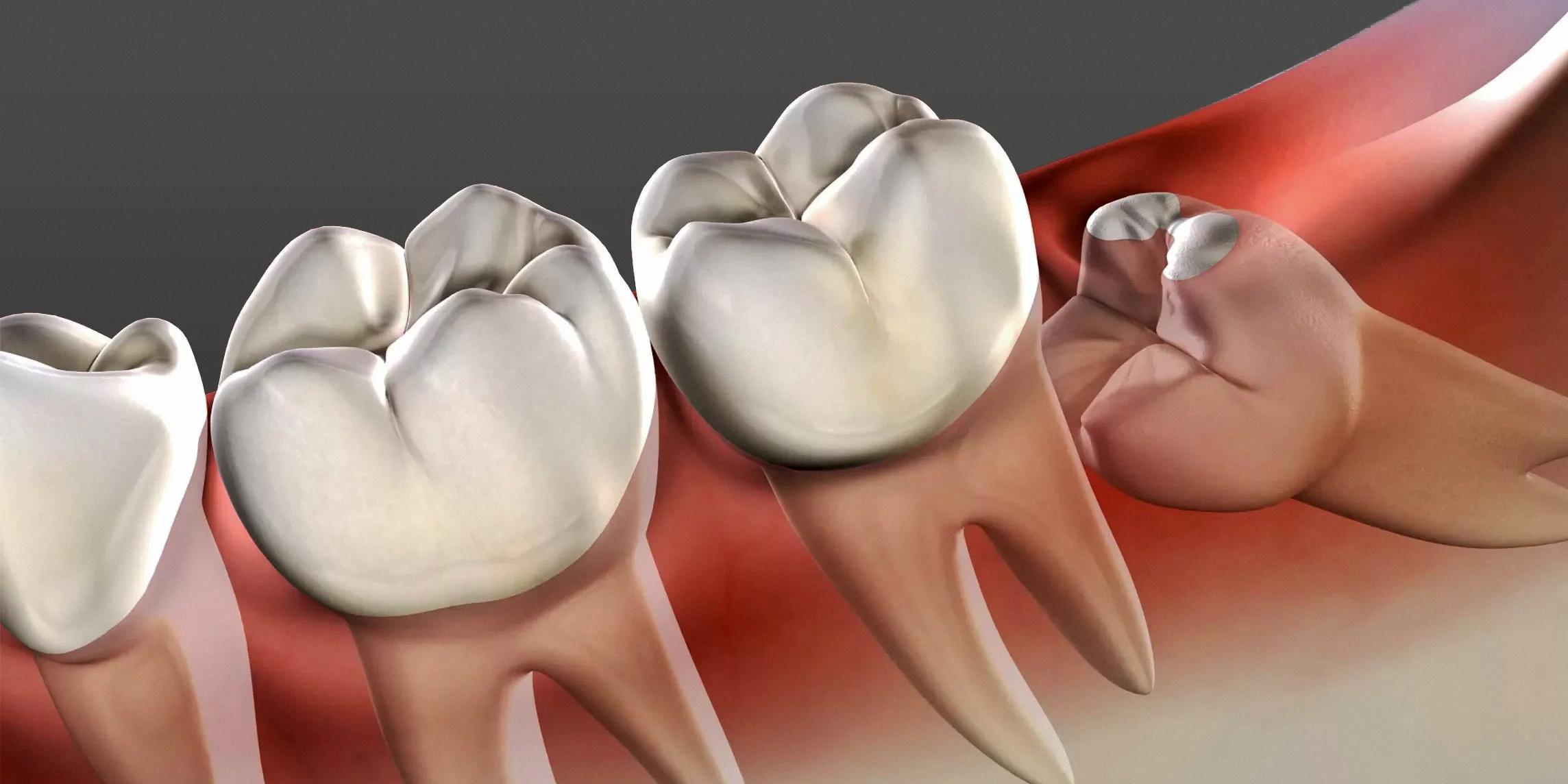 can wisdom teeth fall out naturally