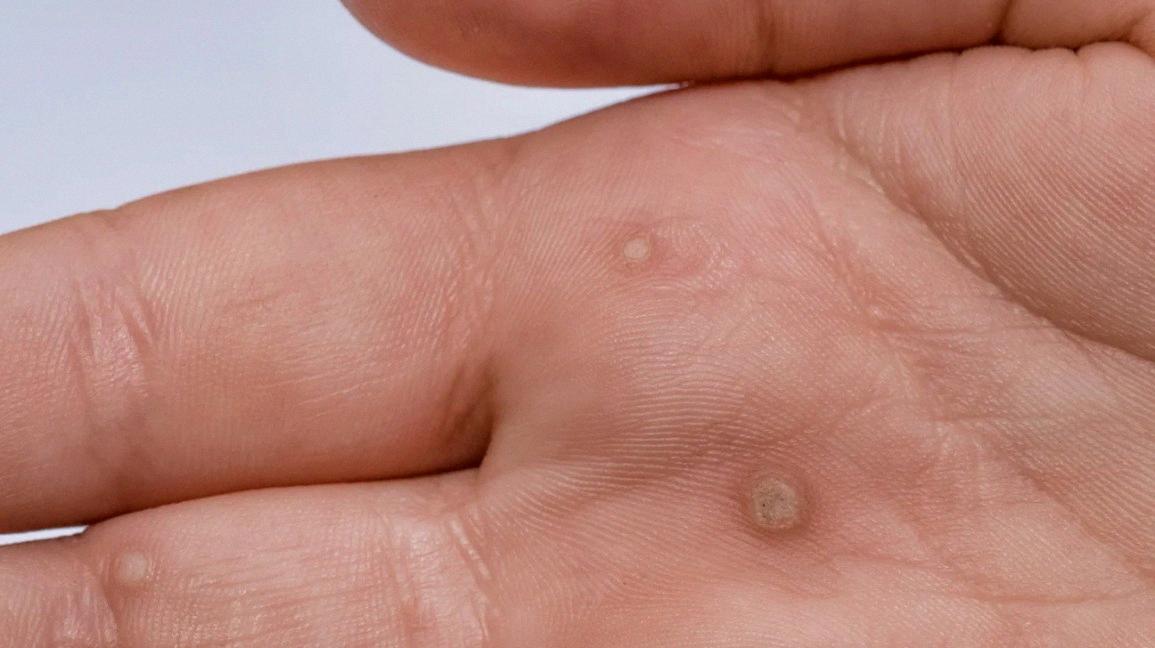 Cutting Off a Wart Safe and Effective Removal Advice