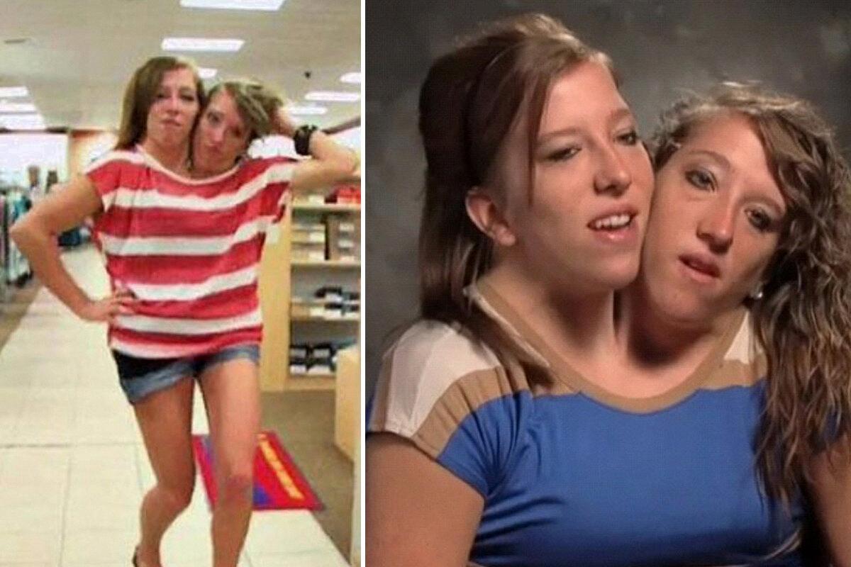 conjoined twins abby and brittany pregnant