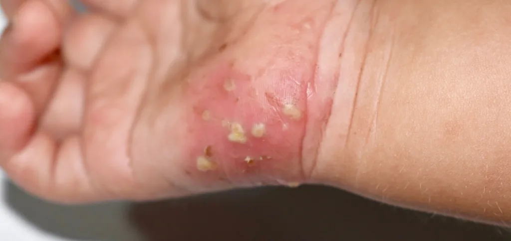 scabies 1674954435