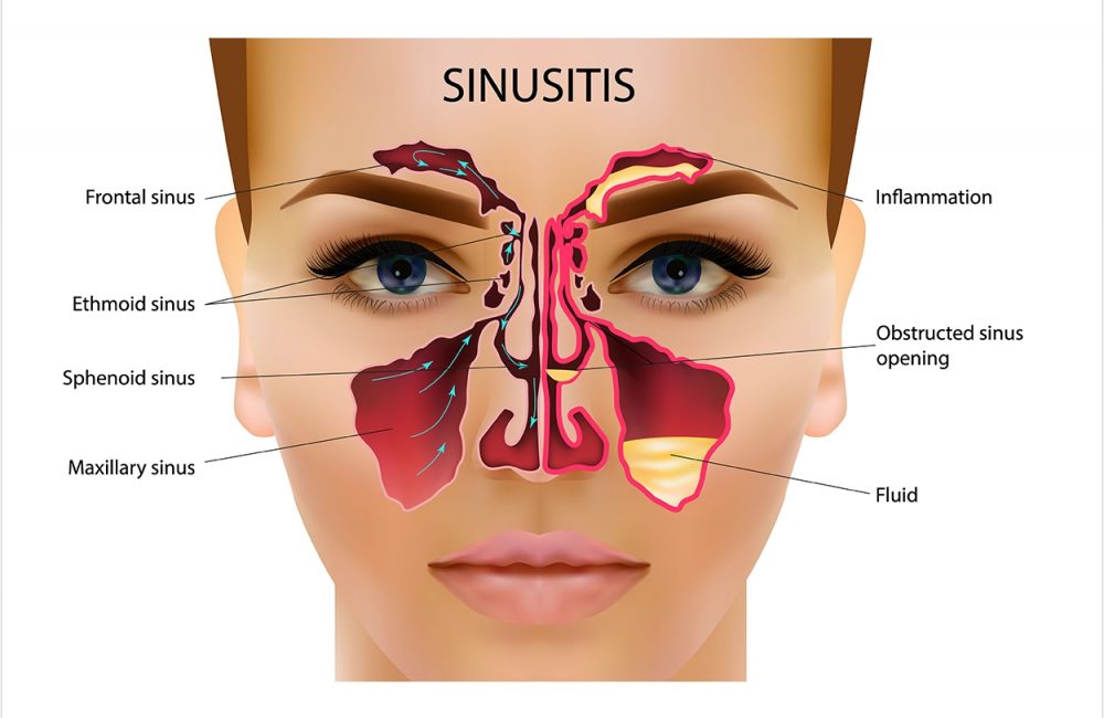 sinusitis 1674908955