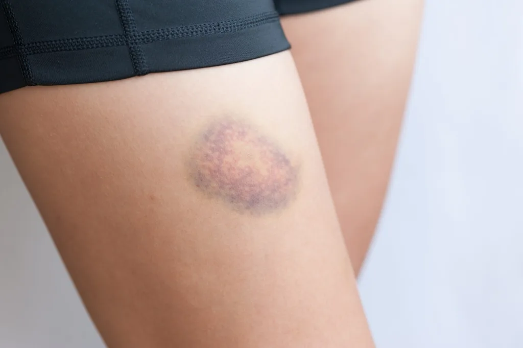 skin bruise 1674506670