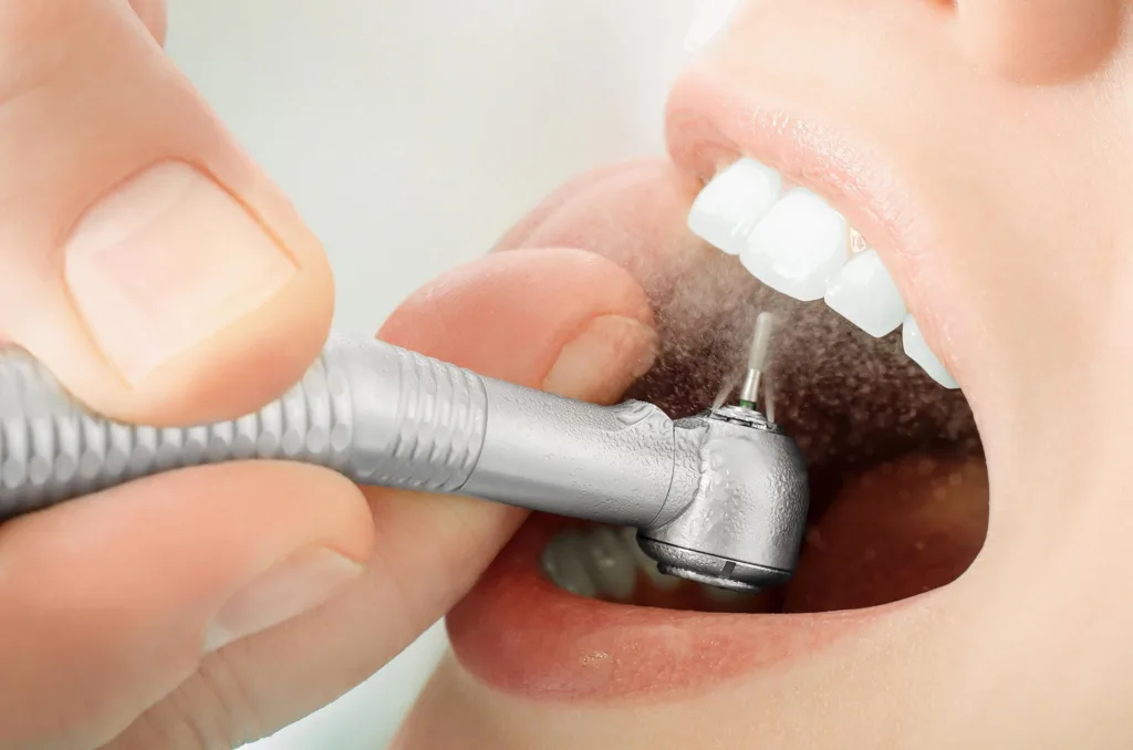 Dental Fillings A Guide to AfterCare Effects