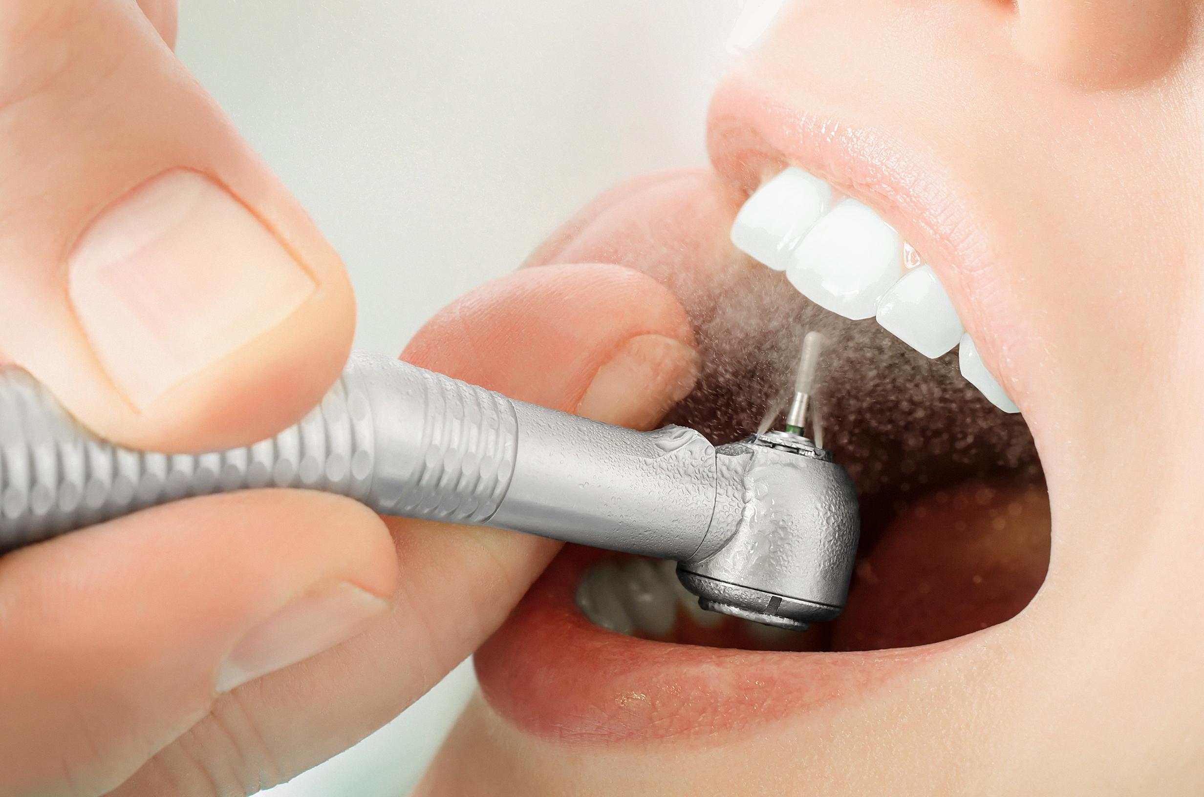 do fillings smooth out over time