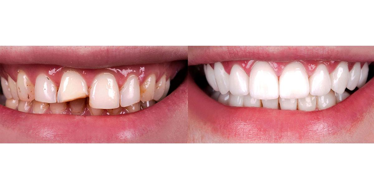 do fillings smooth out over time