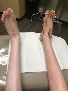 does removing stitches hurt 1 1