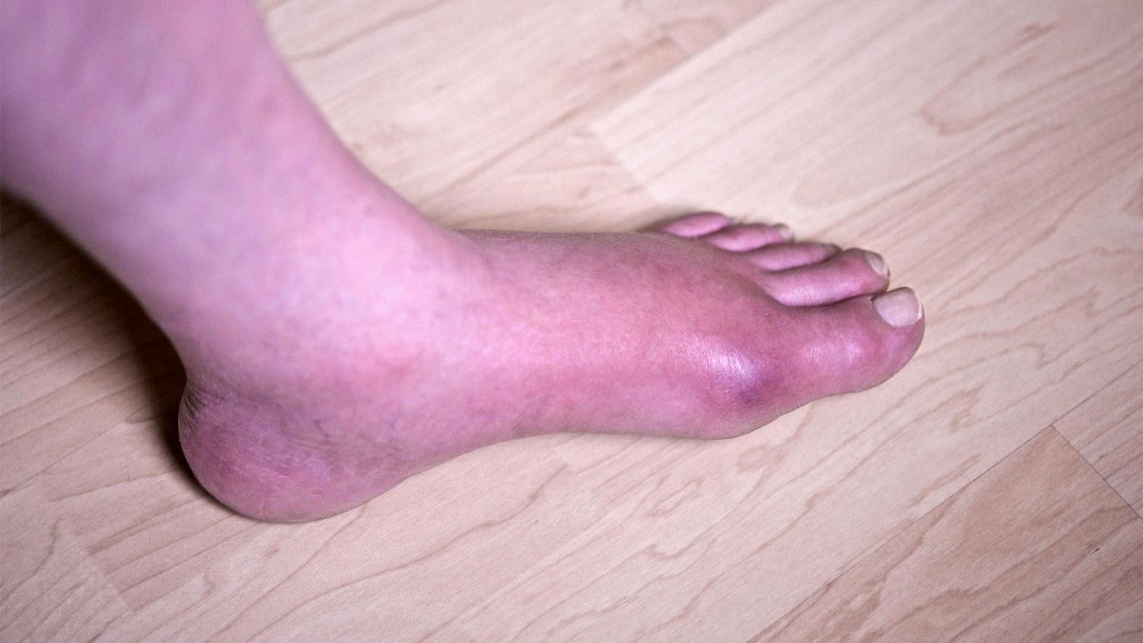 does walking on gout foot make it worse