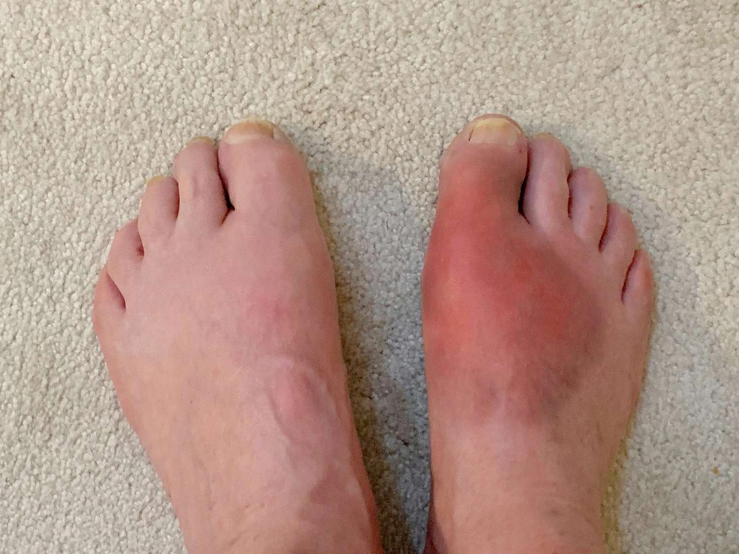 does walking on gout foot make it worse