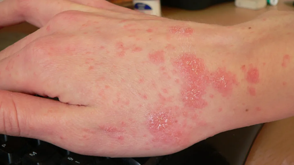 scabies treatment 1679766579