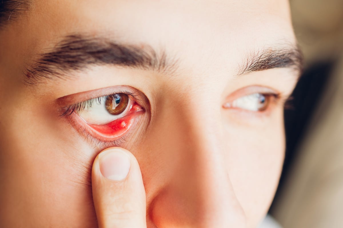 Stye Causes, Care and Treatment