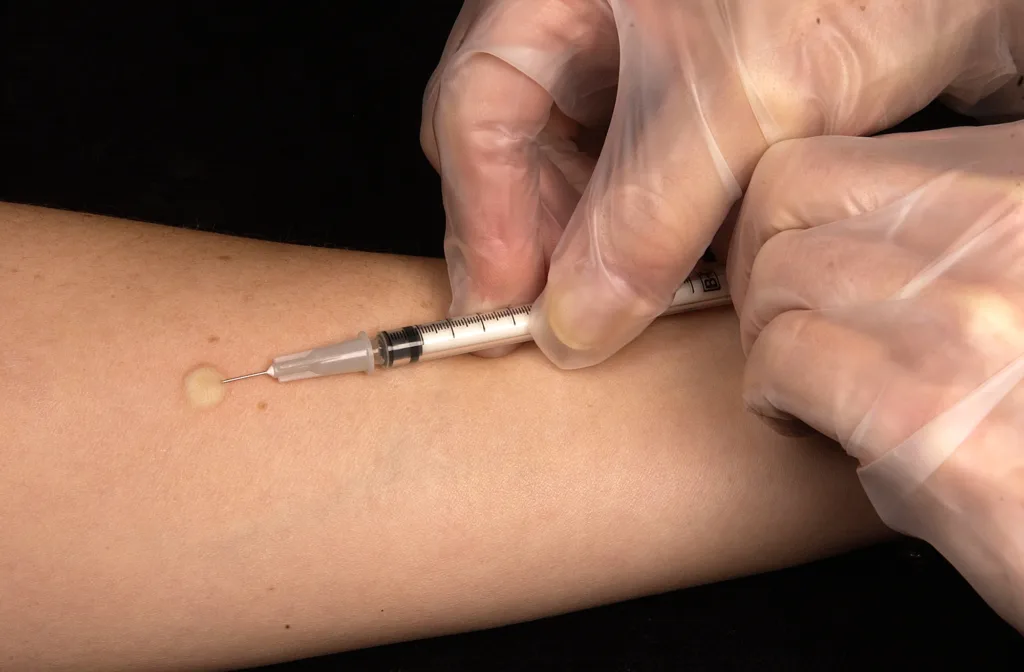 tuberculin skin test 1678785624