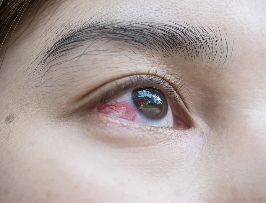 broken blood vessel in the eye 1681578793