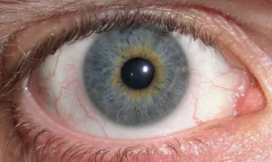 central heterochromia 1682825555