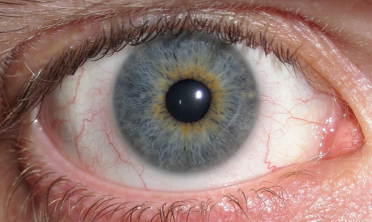 Central Heterochromia A Rare Eye Condition