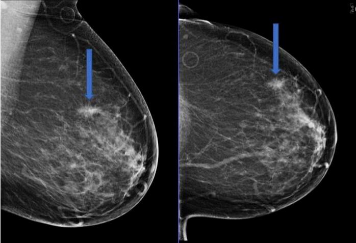 focal asymmetry should i be worried