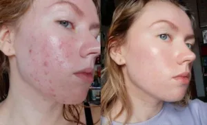 gua sha breakout 1 1