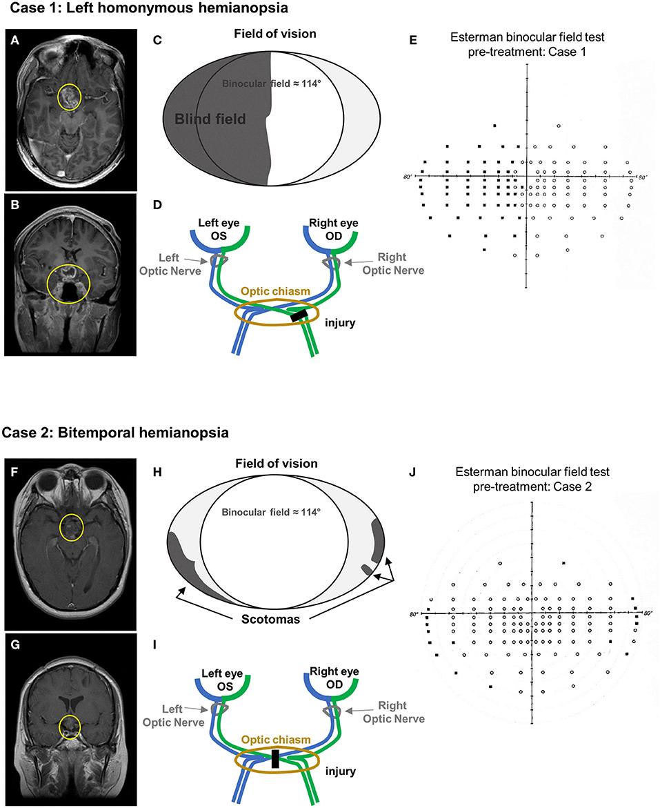 hemianopia is caused by __________.