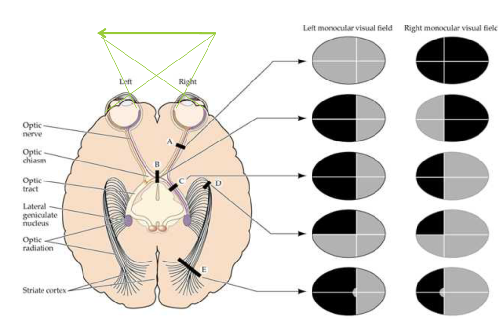 hemianopia 1681495729