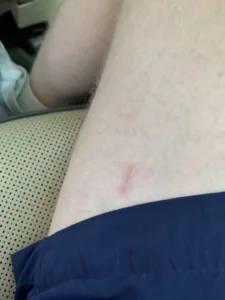 herpes inner thigh 1681497869