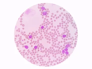 high lymphocyte 1681548227