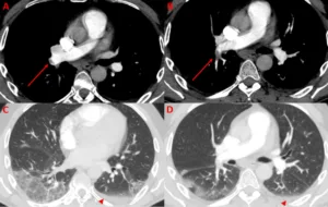 how long before a pulmonary embolism kills you 1 1