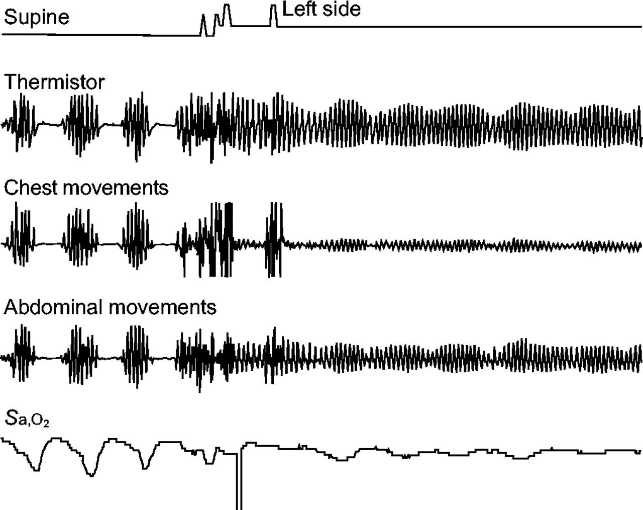 the-stages-of-cheyne-stokes-breathing