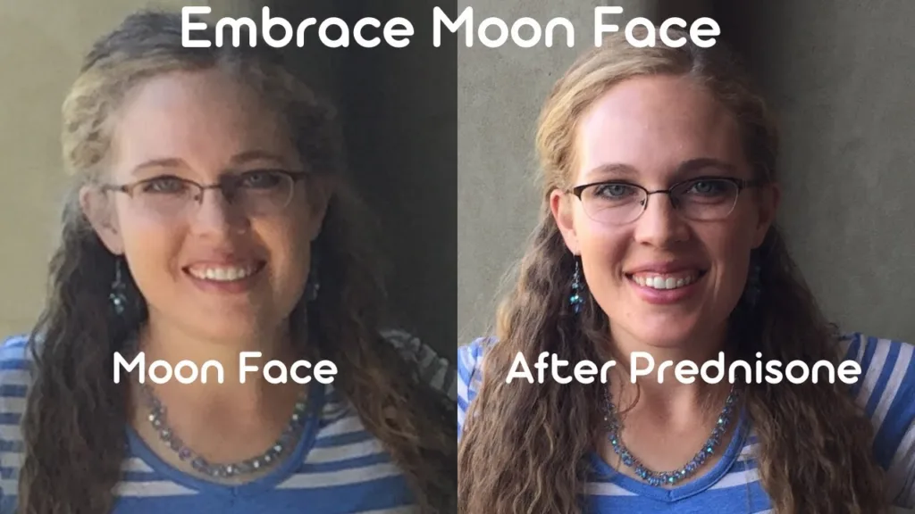 moon face steroid 1682142362