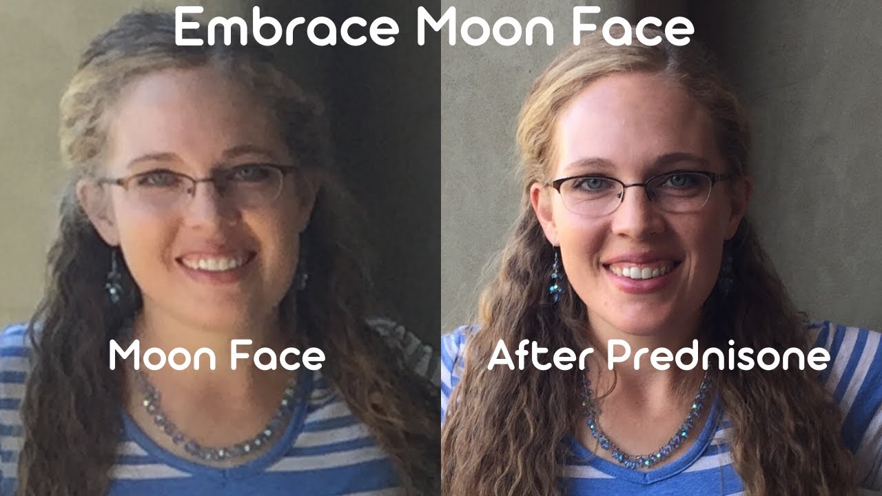 moon-face-bothering-you-read-this