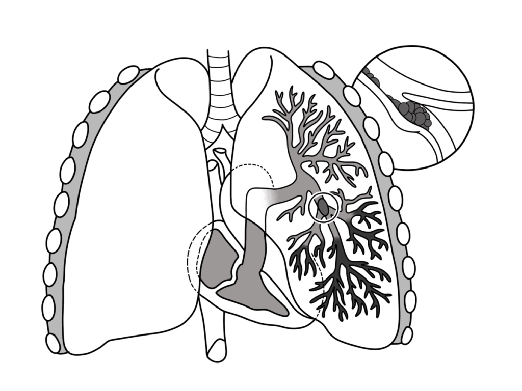 pulmonary embolism 1682066284