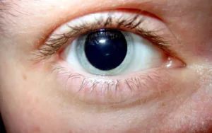 pupil dilation 1680332264