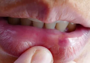 busted lip 1683198472
