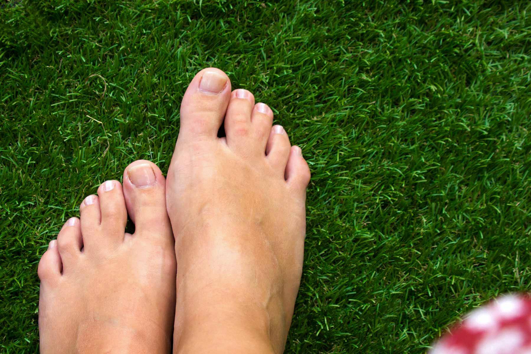 Living with Webbed Toes Syndactyly in Humans