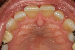 incisive papilla swollen 1