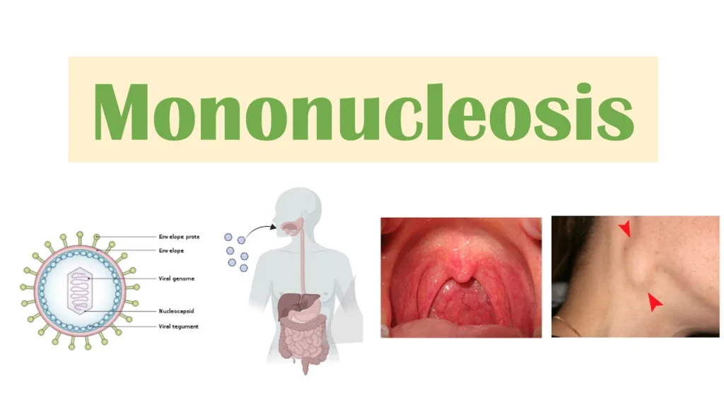 mono kissing disease 1683800719