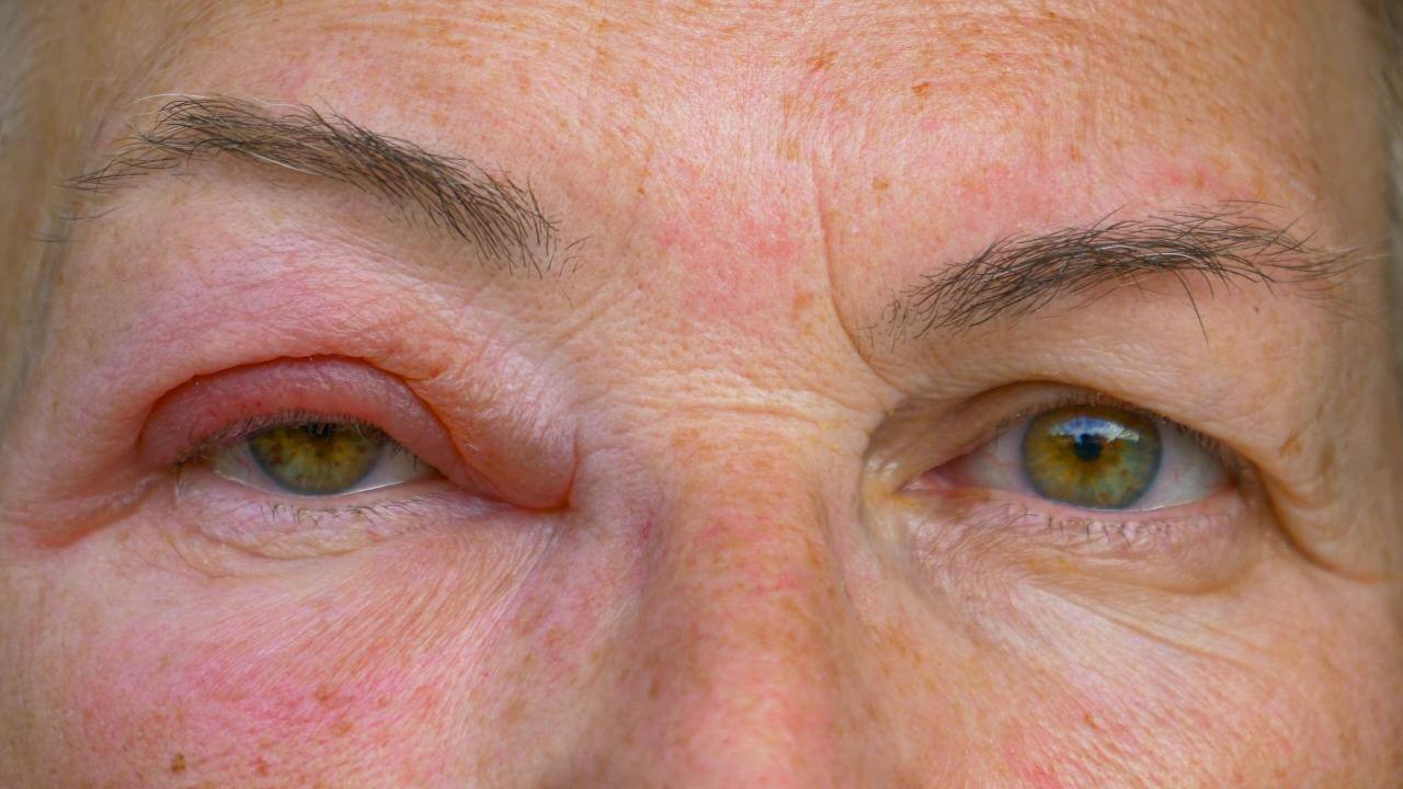 Proper Management Of Lacrimal Caruncle Swelling