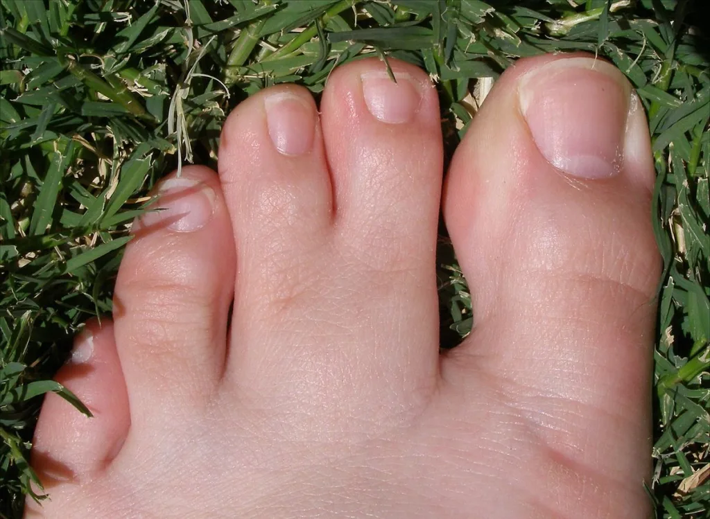 webbed toes human 1683106845