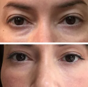 PRP eye treatment 1685808675