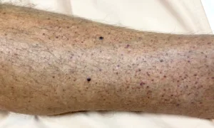 Petechiae 1685637310