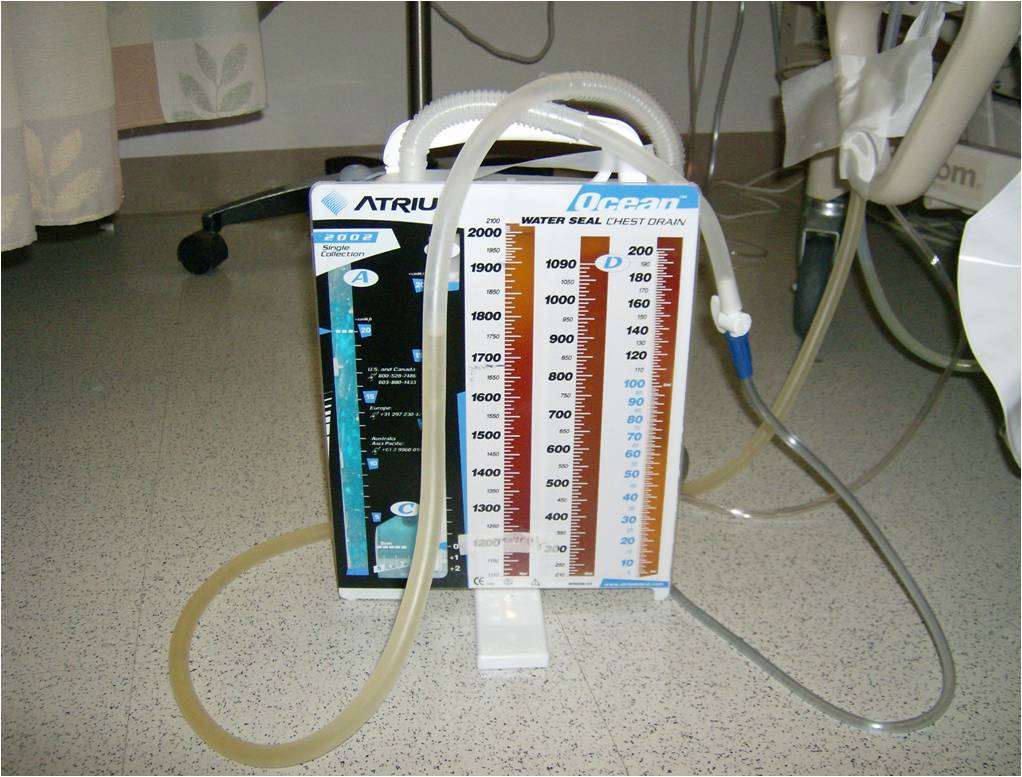 Assessment of Tidaling in Chest Drainage Units