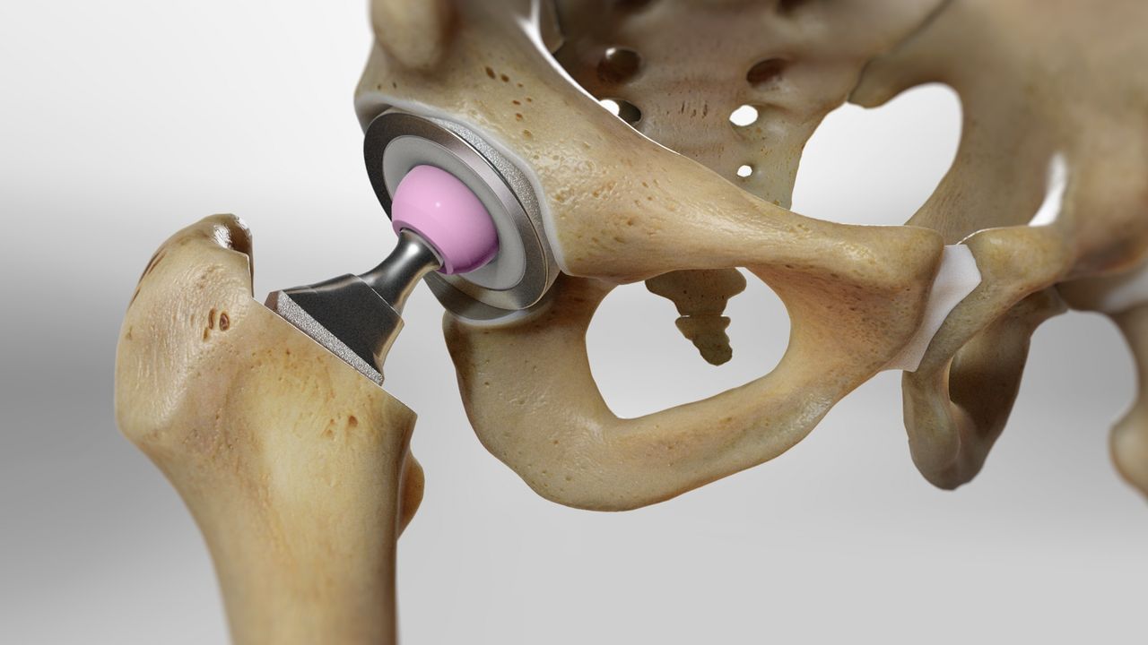 hip-replacement-recovery-timeline