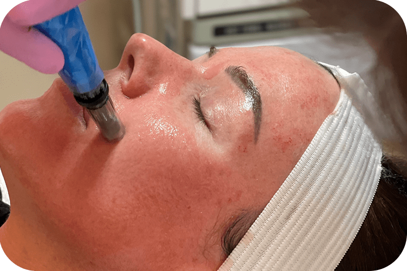 microneedling 1686648401