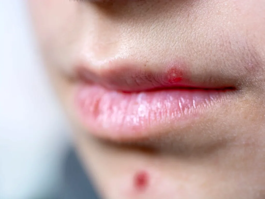 pimple on lips 1686904497
