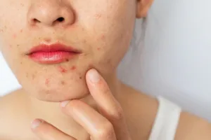 swollen lip with pimple 1 1